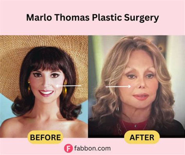 Did Marlo Thomas Undergo Face Surgery? Before And After Photos On IG