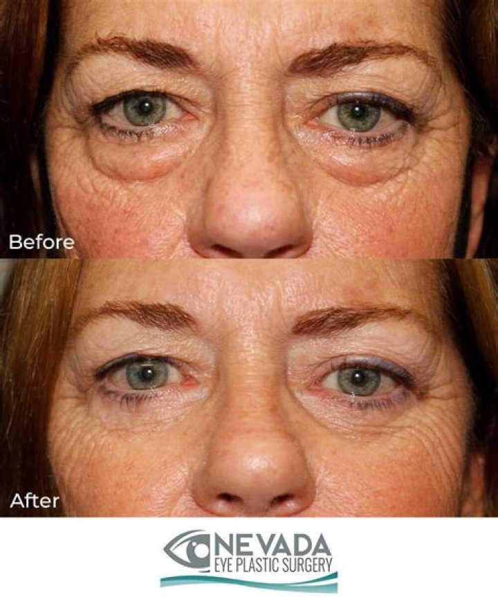 Does Lily Collins Have Implants? Eye and Plastic Surgery Update, How Does She Look Now?