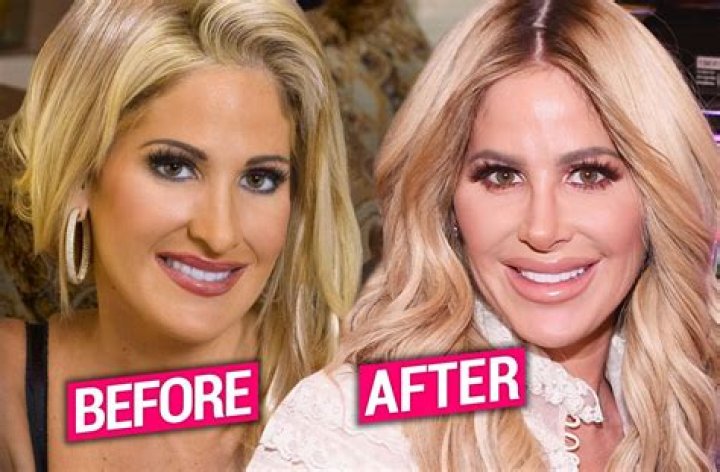 Kim Zolciak-Biermann Before Surgery Pics, Nose Job Age And Partner